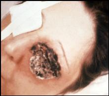 cutaneous anthrax pictures